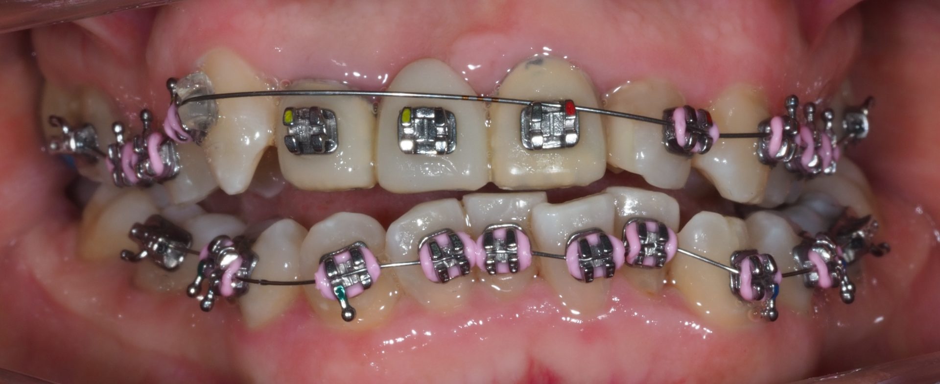 Caso Cl Nico Con Brackets Met Licos Precision Ortodoncia Y Pr Tesis En