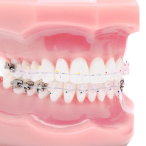 ortodoncia estética autoligado estético