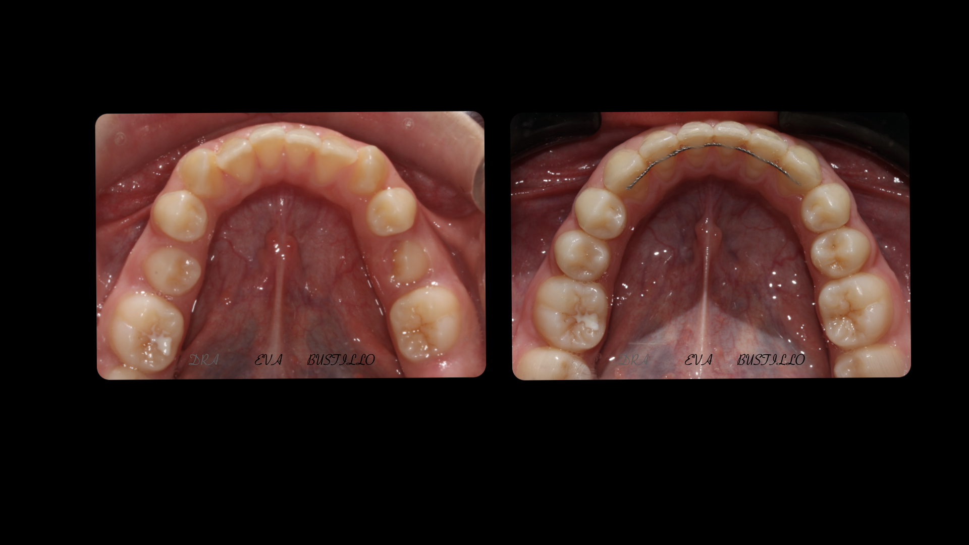 retención fija en ortodoncia caso clínico