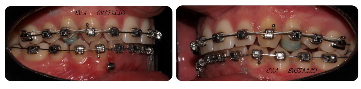casos de ortodoncia complejos por la doctora eva bustillo