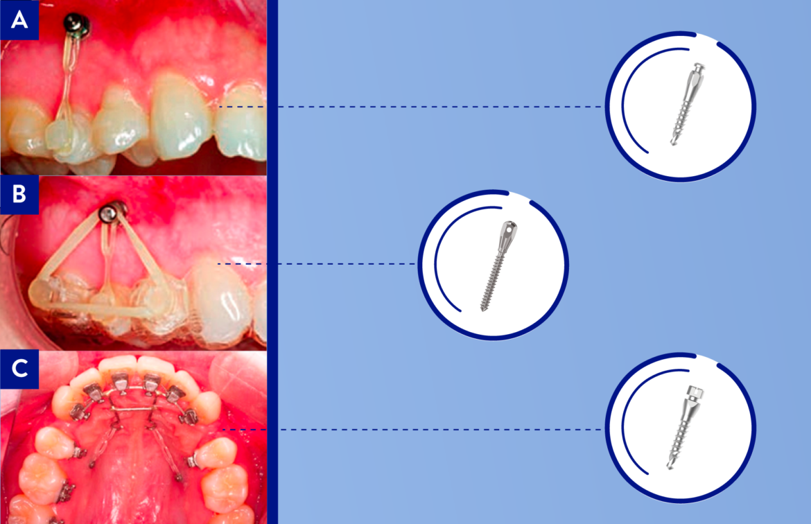 Aplicación de mini implantes con alineadores cuál es la mejor forma Bracket